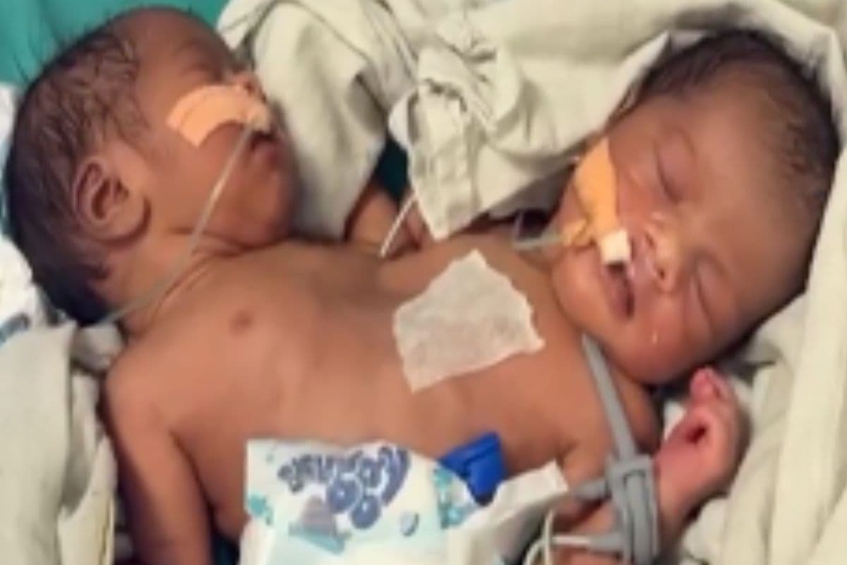 चमत्कार! इंदौर में 21 दिनों में दूसरी बार जन्मी अनोखी बच्ची, दो सिर-चार हाथ और दो दिल, डॉक्टर हैरान