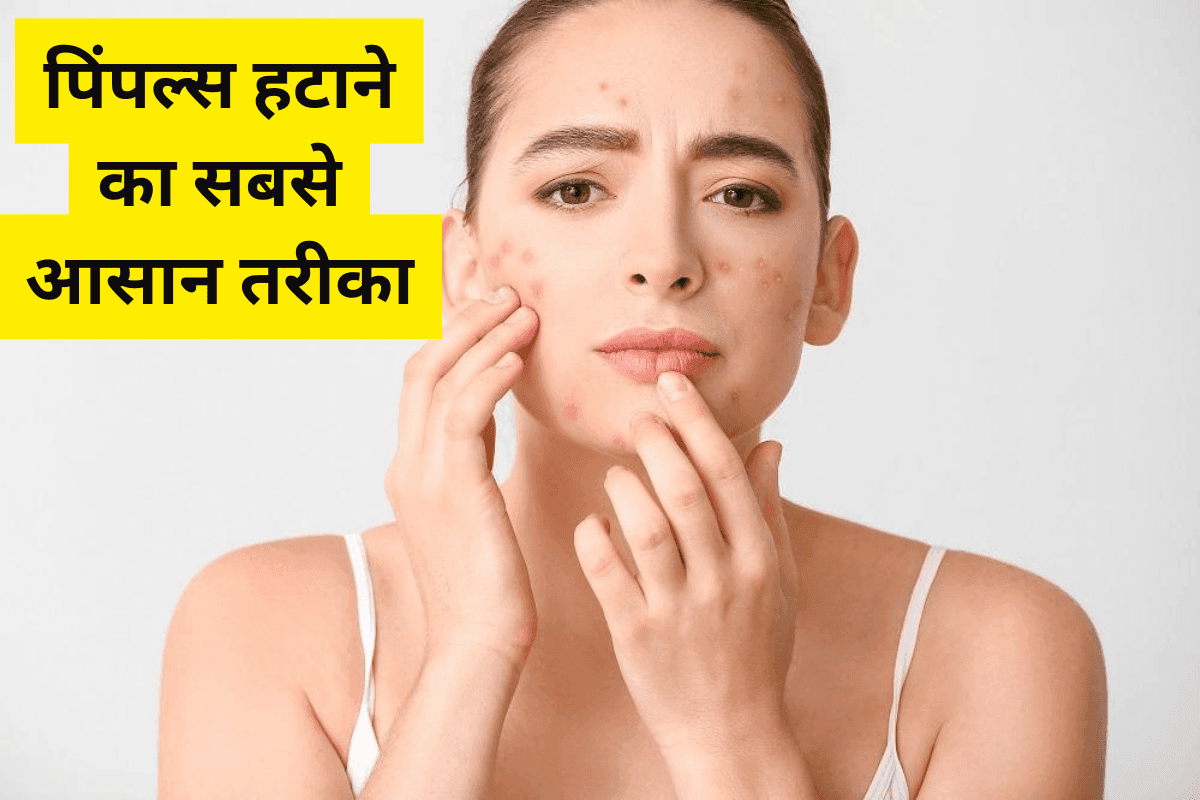 Home Remedies For Pimples
