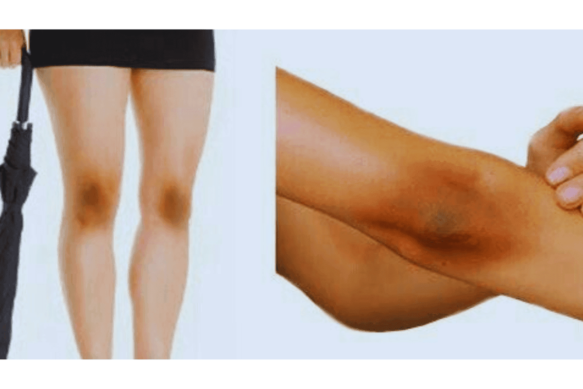 Elbow darkness removal home remedies