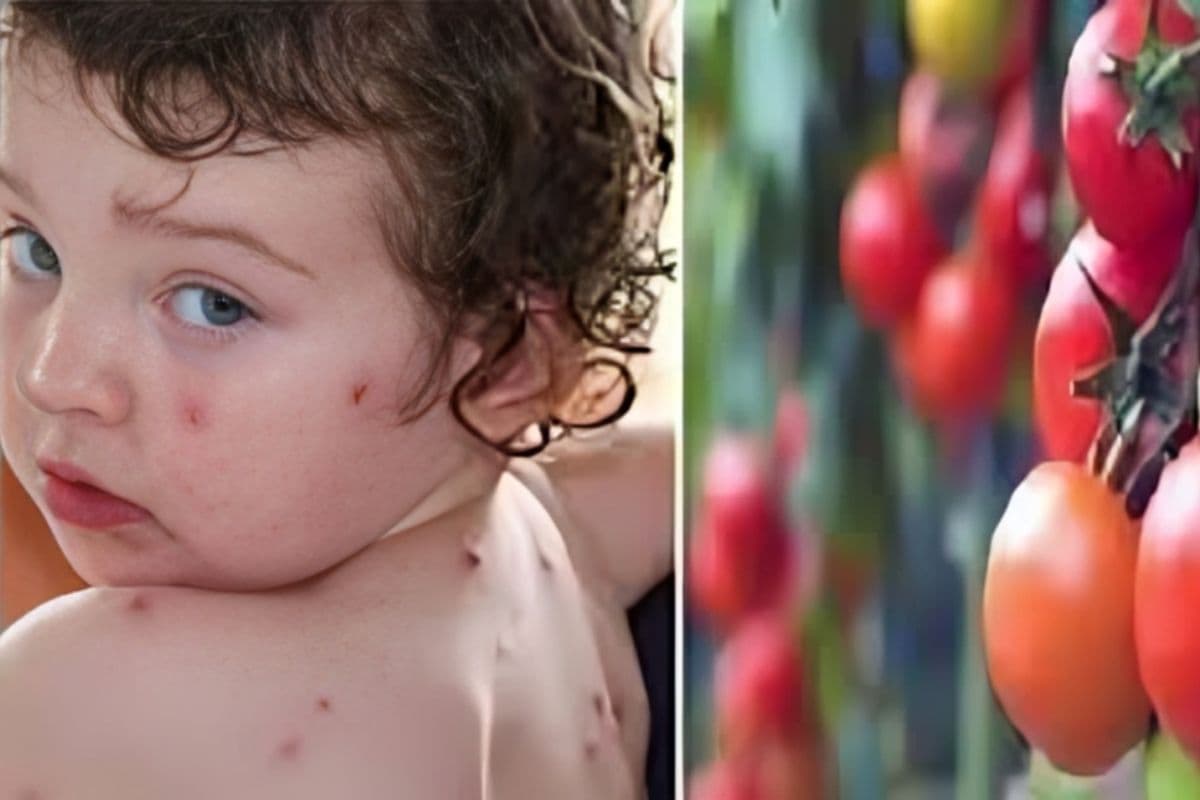Tomato Flu In Bihar: बच्चों को जकड़ रहा टोमैटो फ्लू, तेज बुखार और लाल दानों से रहें सतर्क