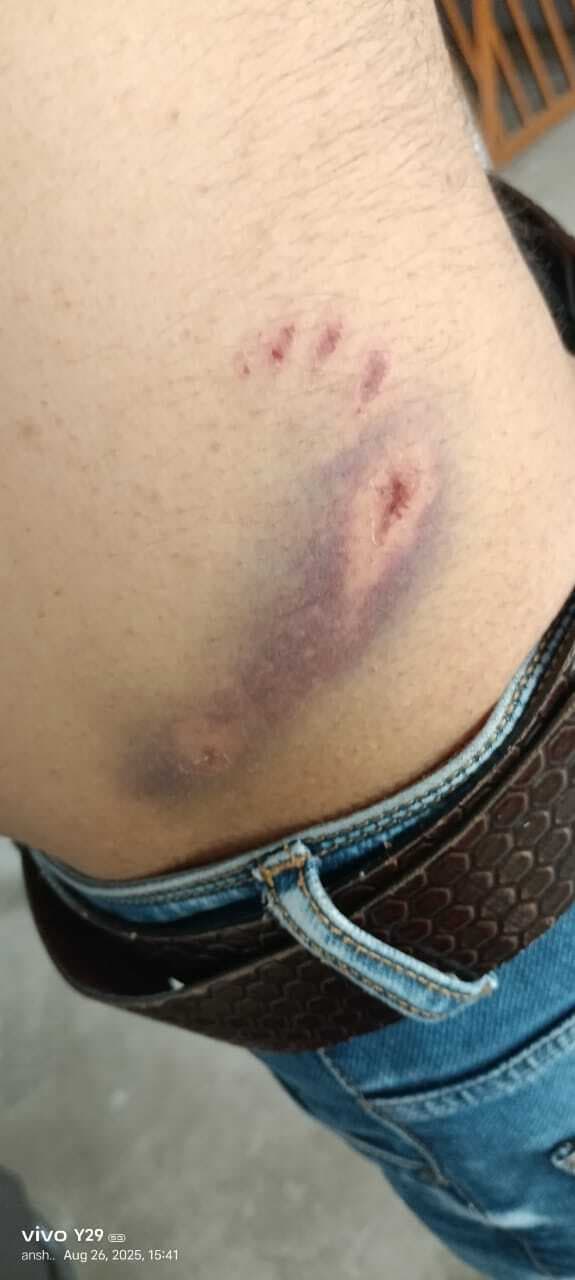 कुत्ते ने हमला कर एक शख्स को किया घायल, कुत्ते के मालिक पर केस दर्ज