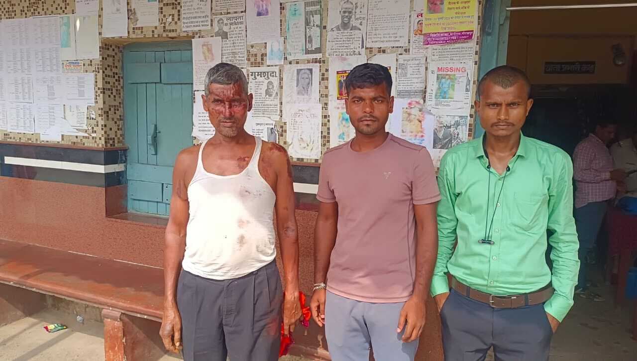 Deoghar news : चलती ट्रेन में छिनतई असफल होने पर अपराधी ने फेंका तेजाब,  यात्री का चेहरा झुलसा