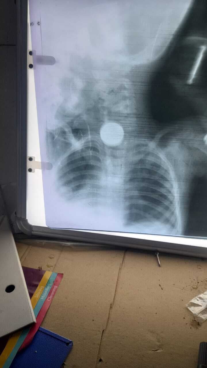 चार वर्षीय बालक ने निगला सिक्का, दुमका रेफर