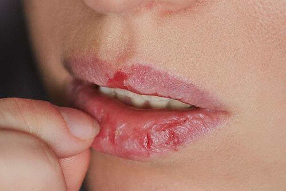 Cracked Lips Home Remedies: सूखे और फटे होंठों से पाएं राहत इन आसान घरेलू नुस्खों से, होंठ बनेंगे गुलाबी और मुलायम