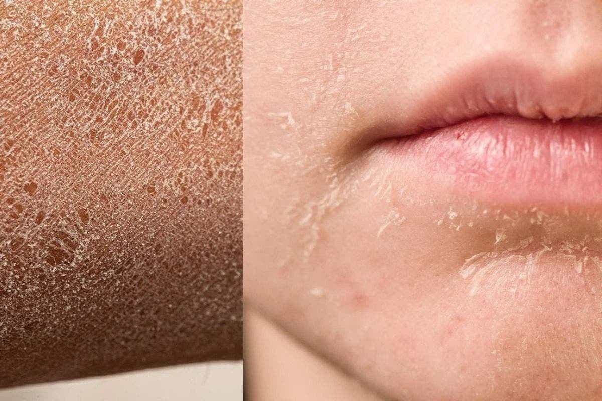 Skin Care Tips: सर्दी आते ही स्किन पर दिख रहे हैं क्रैक्स? अपनाएं ये आसान घरेलू नुस्खे और पाएं मुलायम त्वचा