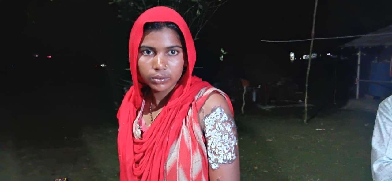 विवाहिता के ऊपर गर्म पानी डालकर जला देने मामले में प्राथमिक दर्ज