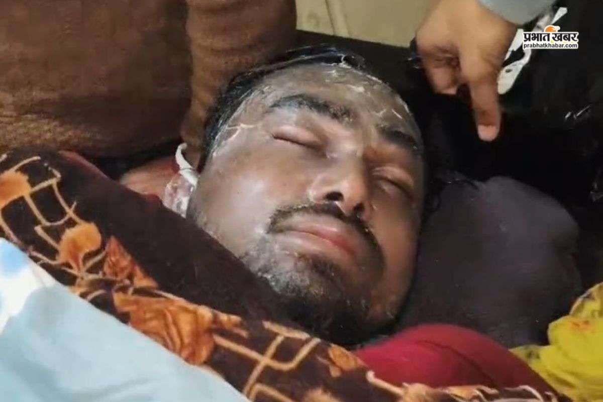 कहासुनी से हिंसक हुई बाप-बेटे की लड़ाई, पिता ने शरीर पर फेंका खौलता तेल