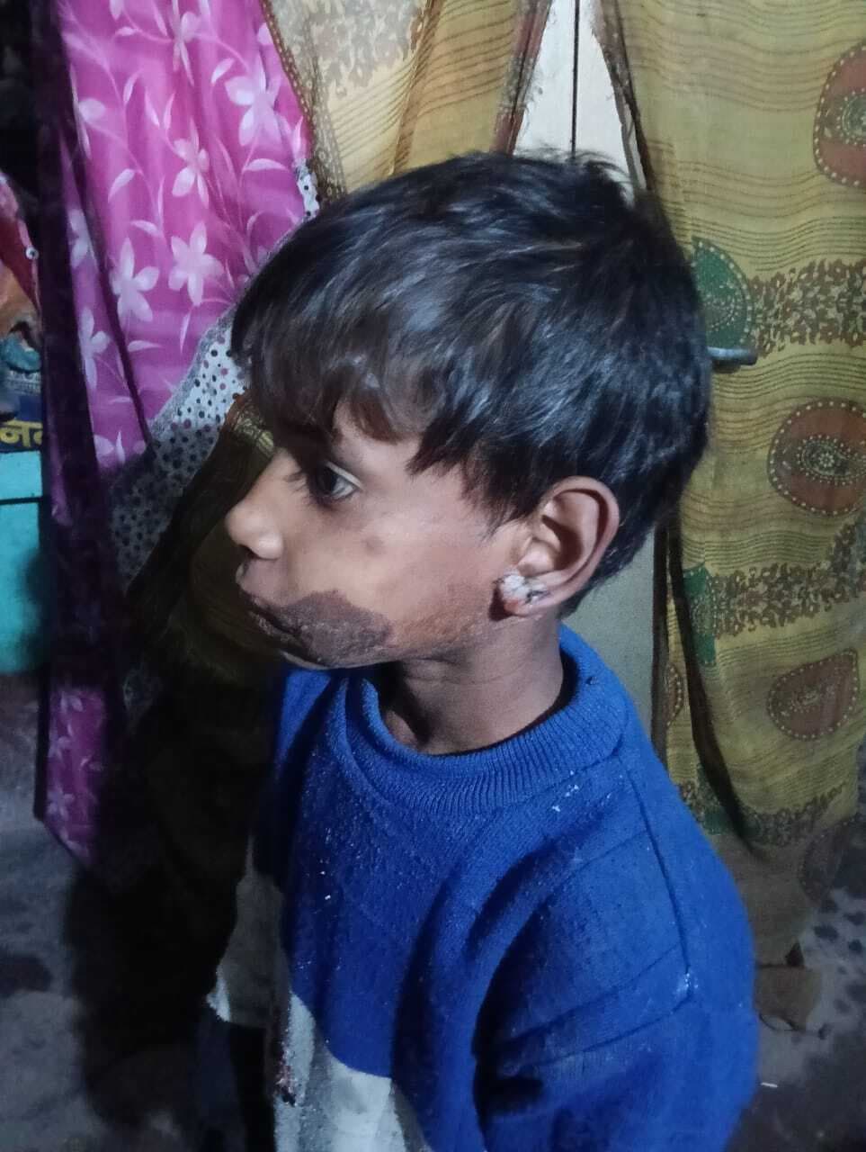 गर्म लोहे के रॉड से चाचा-चाची ने बच्चे के गाल और मुहं के अंदर दागा, जख्मी