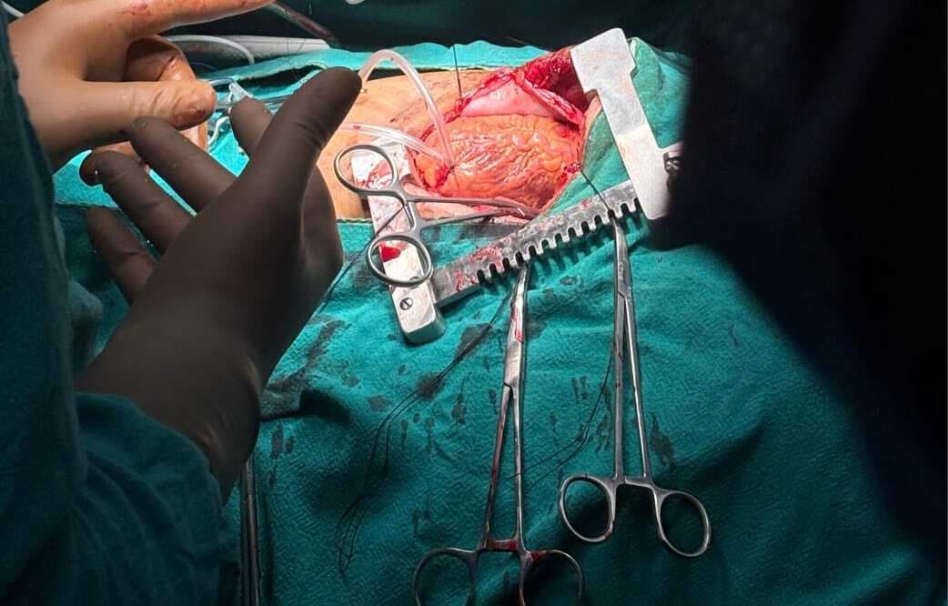 देवघर एम्स में शुरू हुई हार्ट सर्जरी, दो मरीजों का ऑपरेशन सफल