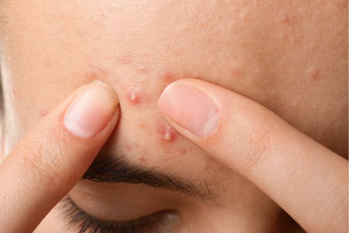 Mistakes that Cause Pimple Marks: पिंपल होते ही करने लगते हैं ये गलतियां, तभी रह जाते हैं दाग-धब्बे Mistakes that Cause Pimple Marks: पिंपल होते ही करने लगते हैं ये गलतियां, तभी रह जाते हैं दाग-धब्बे