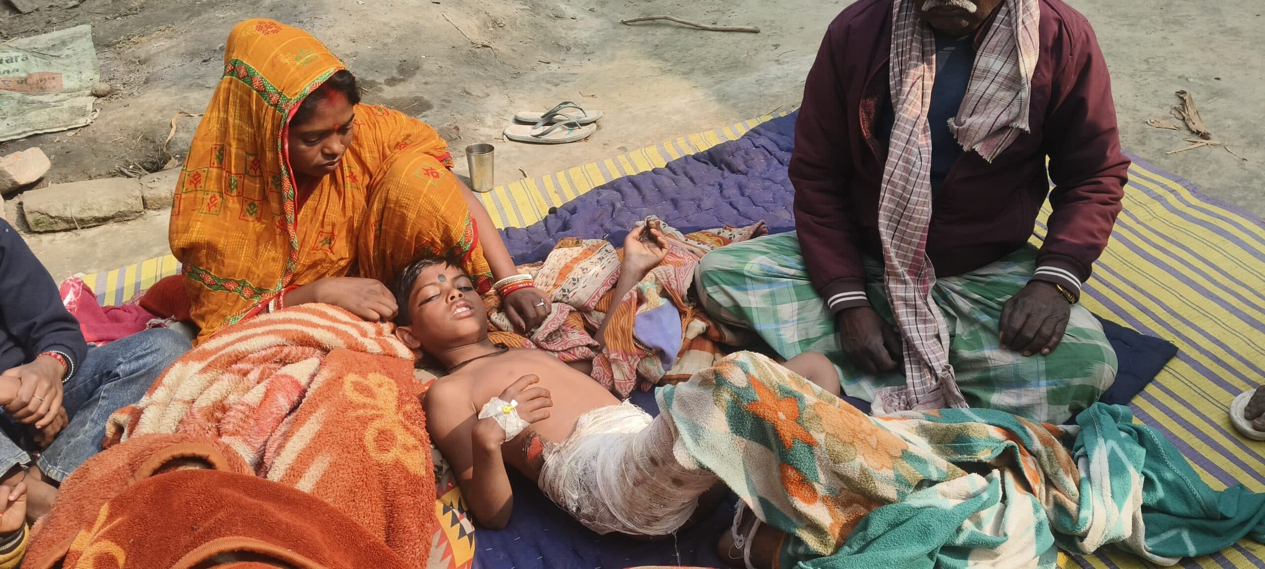 पतंग उतारने में बिजली की चपेट में आया किशोर, झुलसा