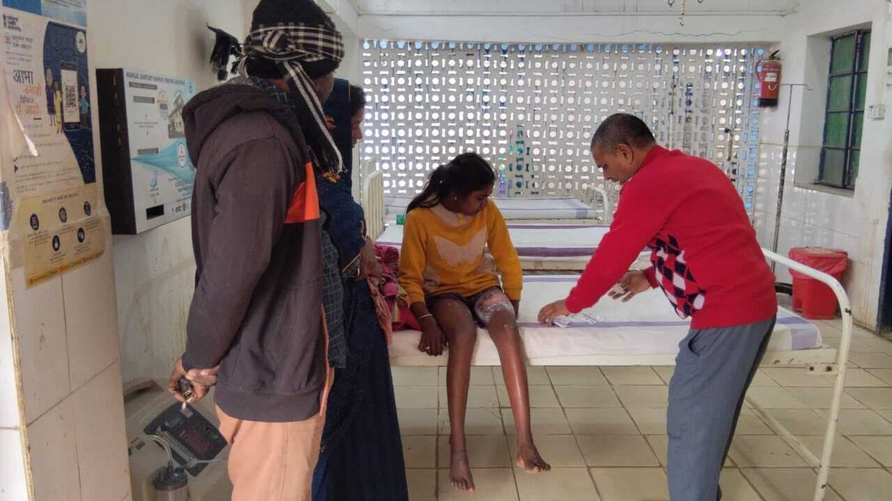 खाना बनाने के क्रम में बच्ची झुलसी, भागलपुर रेफर