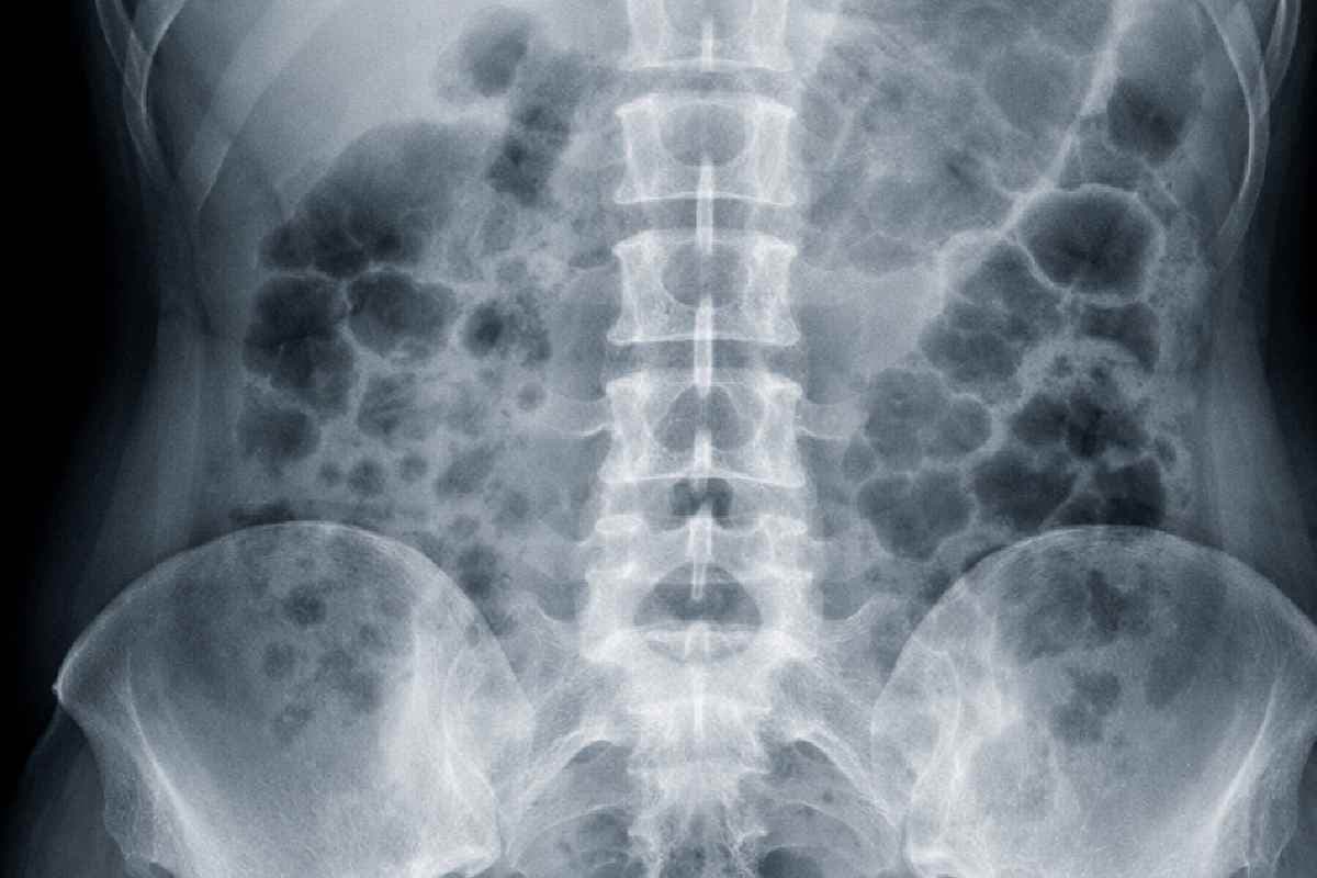 महिला के पेट में सर्जिकल औजार, एक्स-रे रिपोर्ट से सर्जरी के 5 साल बाद हुआ खुलासा