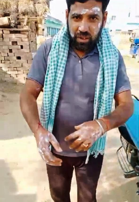 गैस रिसाव से नाश्ते की दुकान में लगी आग, दुकानदार झुलसा