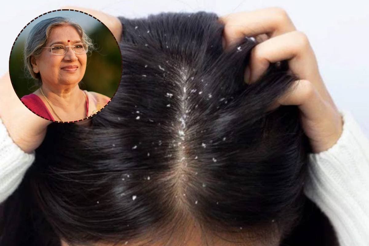 ड्राई स्कैल्प की समस्या से परेशान? डॉ. हंसा जी से जानें आसान घरेलू उपाय और जरूरी टिप्स