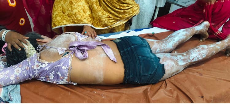 रामनवमी जुलूस में अखाड़ा प्रदर्शन के दौरान हादसा, तीन कलाकार झुलसे