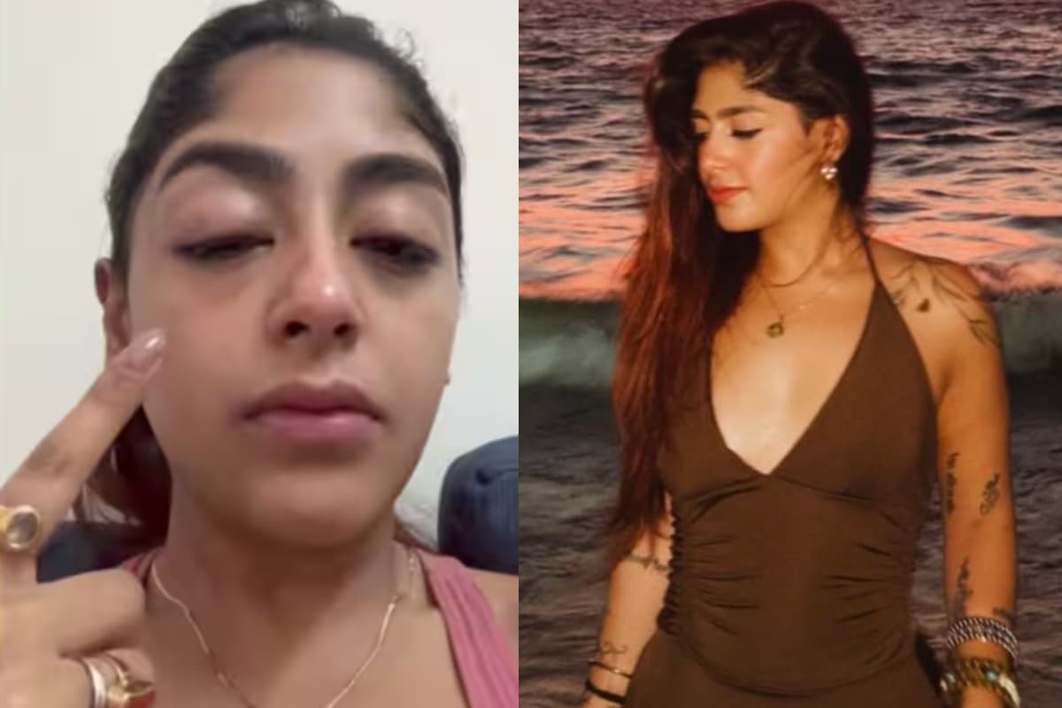 Splitsvilla 16 कंटेस्टेंट पर हमला, टूटा दांत और सूजा चेहरा, देखकर दहल जाएंगे