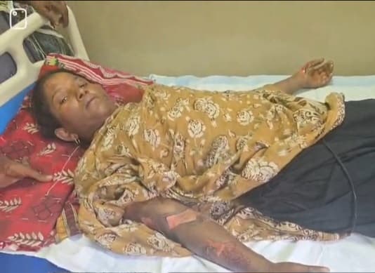 भोजन बनाने के दौरान महिला झुलसी, इलाजरत