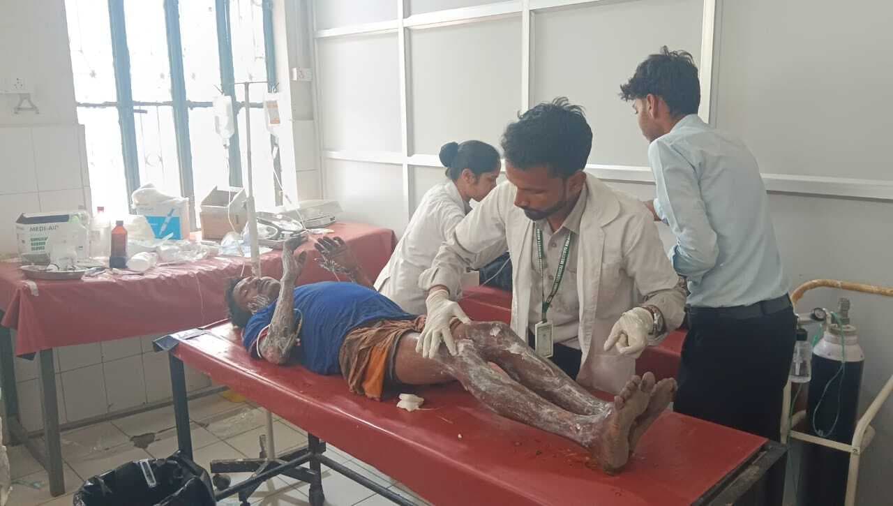 बघिनीकला में आग लगने से झोंपड़ी जली, तीन लोग झुलसे, दो रेफर