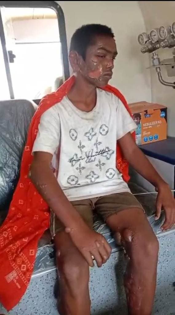 प्यारपुर आग लगने से सैकड़ों बिगहा डंठल जलकर राख, दो किशोर झुलसे