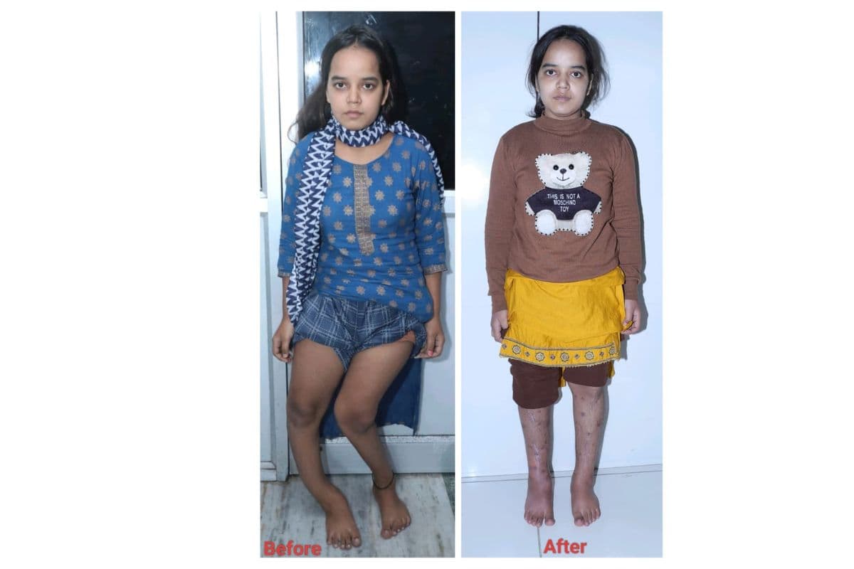 नारायण सेवा संस्थान ने बदली मधुबनी की चांदनी की जिंदगी, गंभीर दिव्यांगता से मिली नई उड़ान