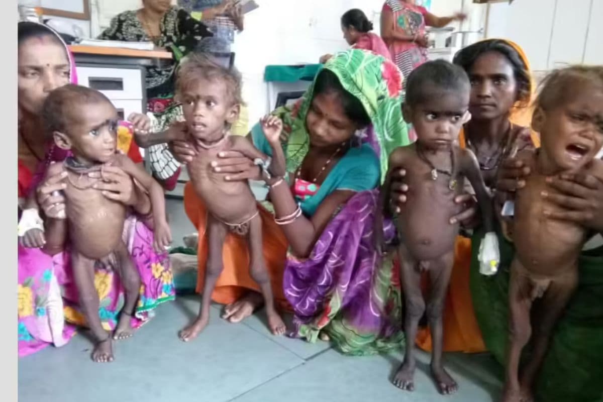 पटना PMCH में कुपोषित बच्चों की मां की भी होगी जांच और इलाज, अलग कुपोषण केंद्र की होगी स्थापना