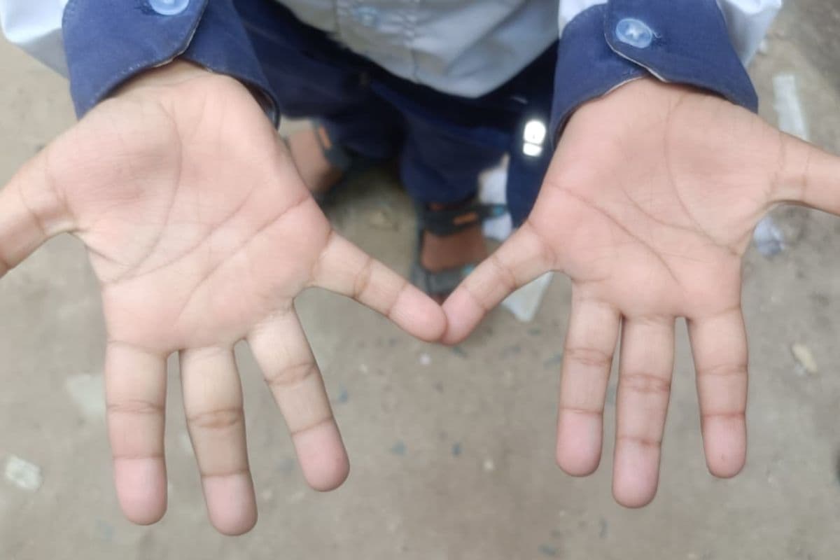 होमवर्क नहीं करने पर यूकेजी छात्र की पिटाई का आरोप, परिजनों में आक्रोश, स्कूल के खिलाफ कार्रवाई की मांग