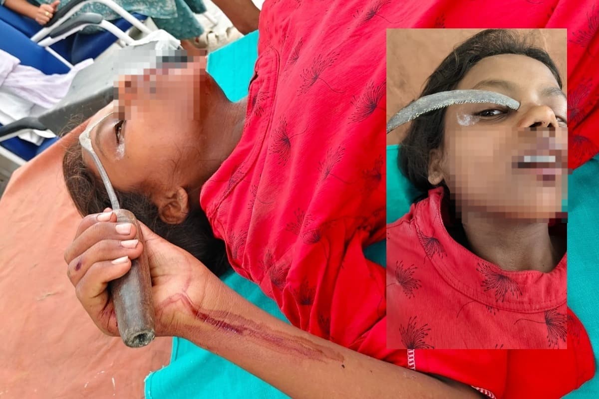 Muzaffarpur: खेत जाने के दौरान पैर फिसला: बच्ची की आंख और चेहरे को चीरता हुआ अंदर घुसा हंसुआ, SKMCH में मिली नई जिंदगी