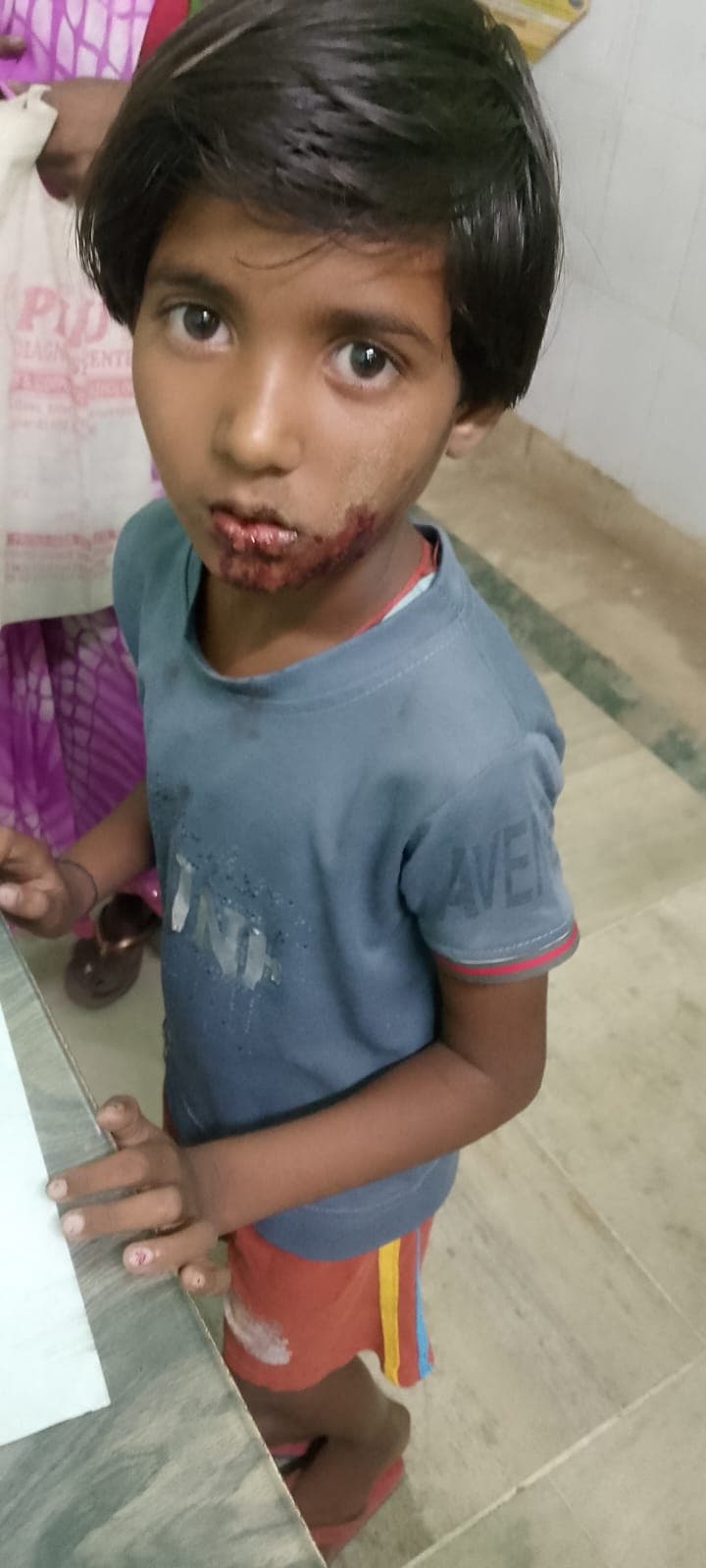 सियार के हमले में बच्ची गंभीर घायल, दुर्घटना में महिला जख्मी