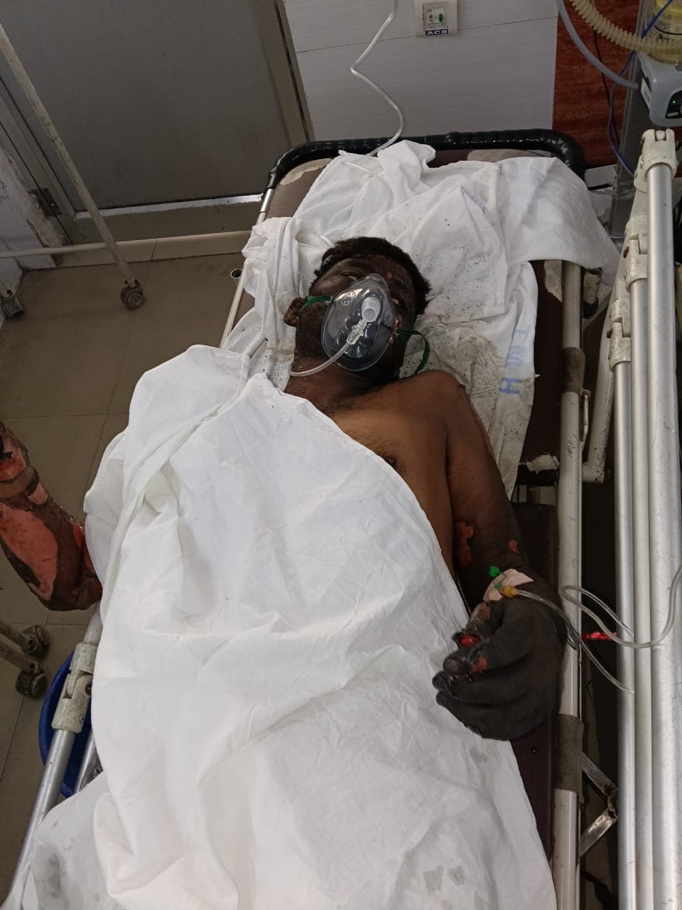 गैलेक्सी इंगोट प्लांट के फर्नेस में ब्लास्ट, बिहार के दो मजदूर झुलसे, हालत गंभीर