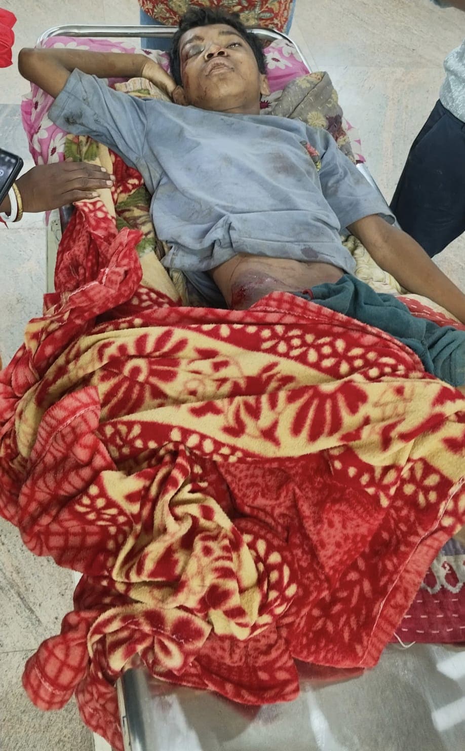 आम तोड़ने के दौरान पेड़ से गिरा छात्र, एमजीएम में इलाजरत