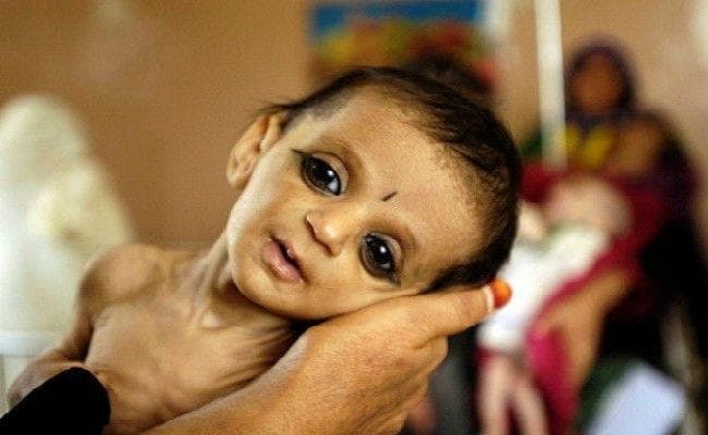 रांची : समाज कल्याण विभाग के अनुसार केवल 19218 बच्चे हैं अति कुपोषित
