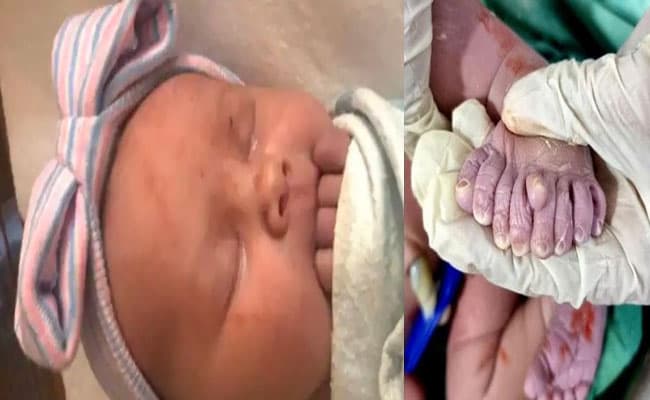 कर्नाटक में घटी अद्भुत घटना, एक पैर में 9 अंगुलियों के साथ बच्चे का हुआ जन्म, परिवार ने कहा भगवान का उपहार कर्नाटक में घटी अद्भुत घटना, एक पैर में 9 अंगुलियों के साथ बच्चे का हुआ जन्म, परिवार ने कहा भगवान का उपहार