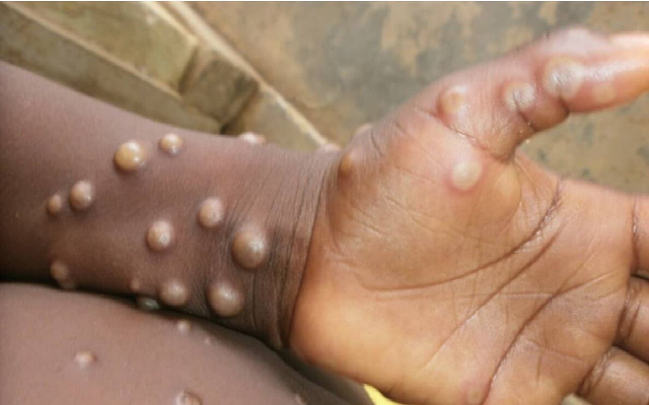Monkeypox in Delhi: दिल्ली में मिला मंकीपॉक्स का 9वां मरीज, देश में संक्रमितों की संख्या हुई 14 Monkeypox in Delhi: दिल्ली में मिला मंकीपॉक्स का 9वां मरीज, देश में संक्रमितों की संख्या हुई 14