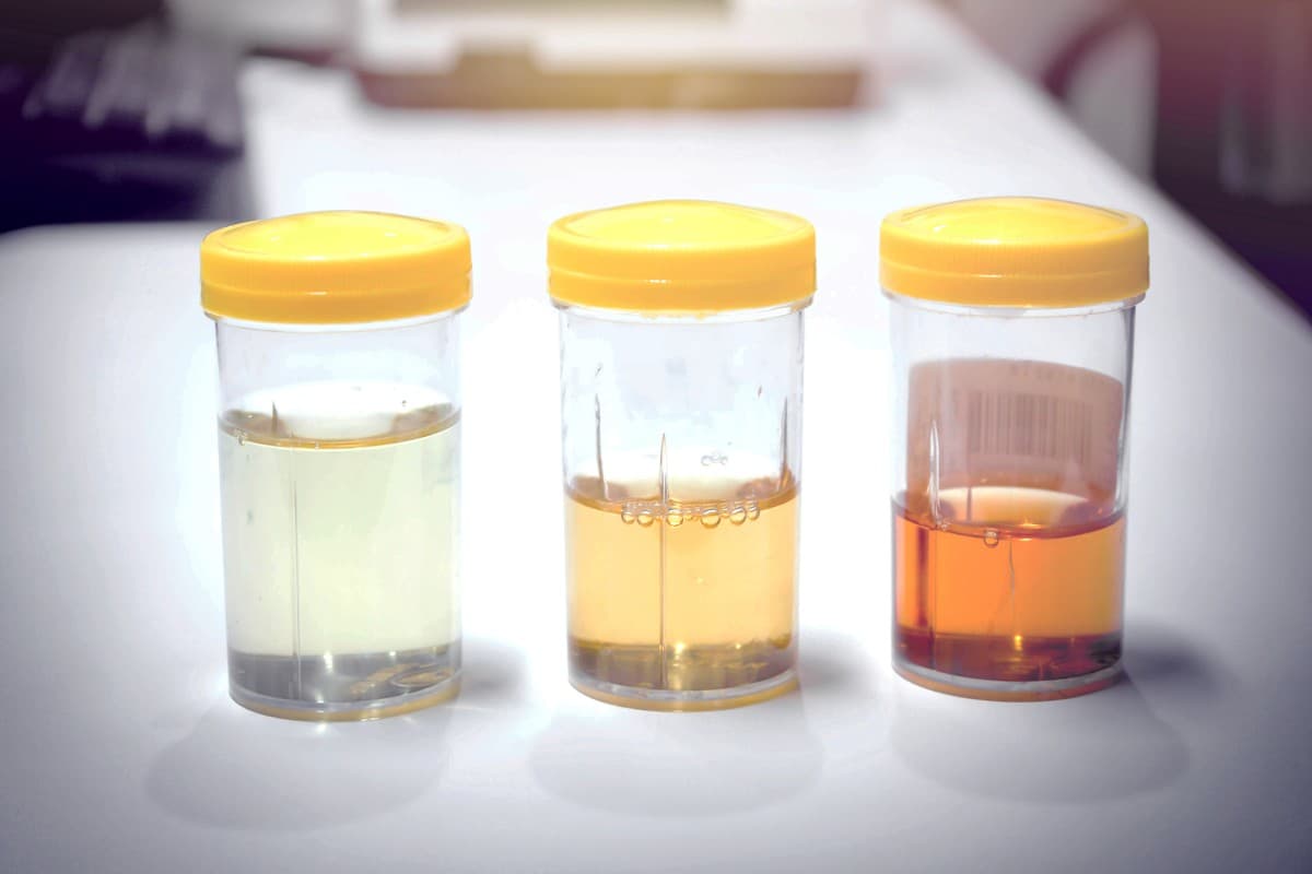 Urine Color Chart: पेशाब के रंग से जानें अपनी सेहत का हाल