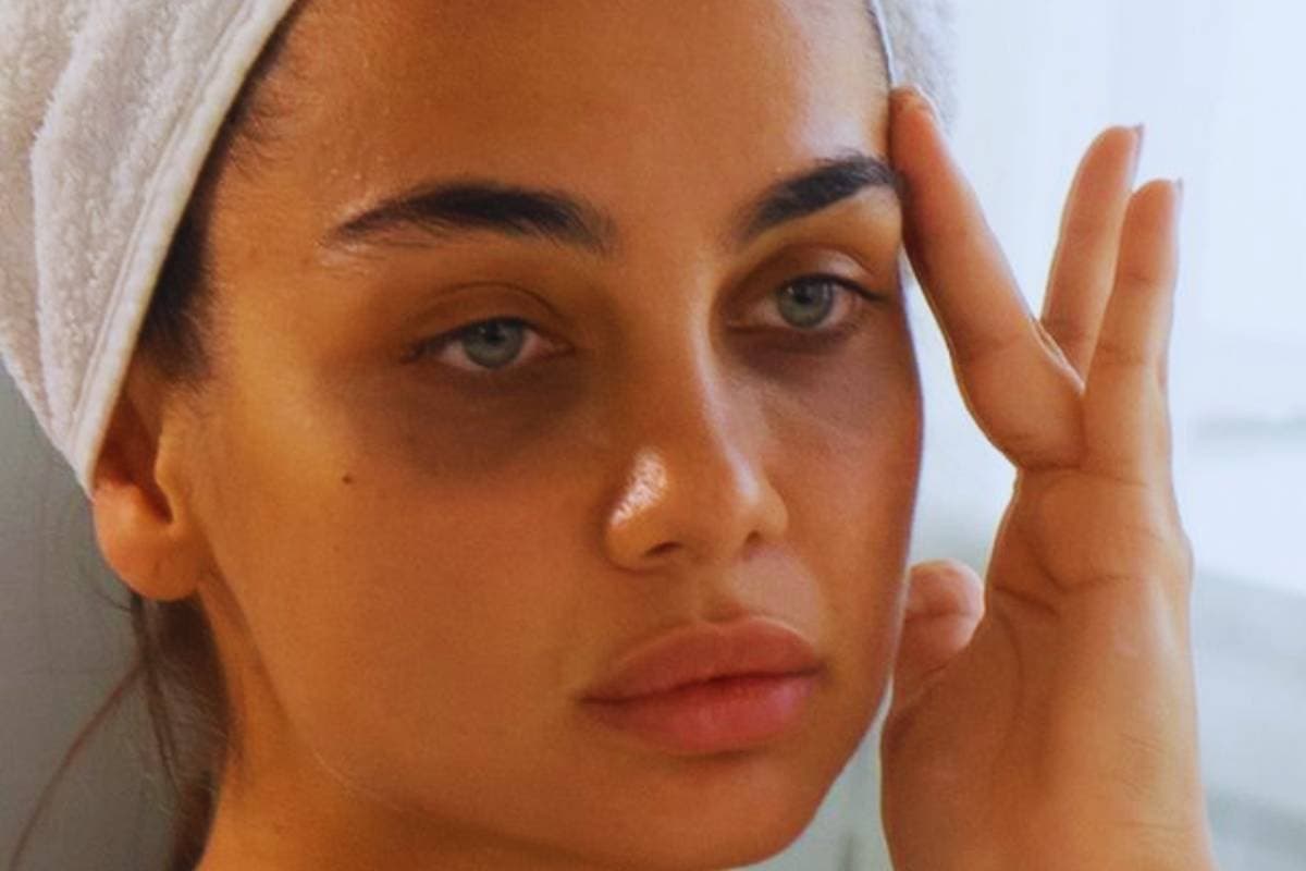 Natural Remedies for Dark Circles