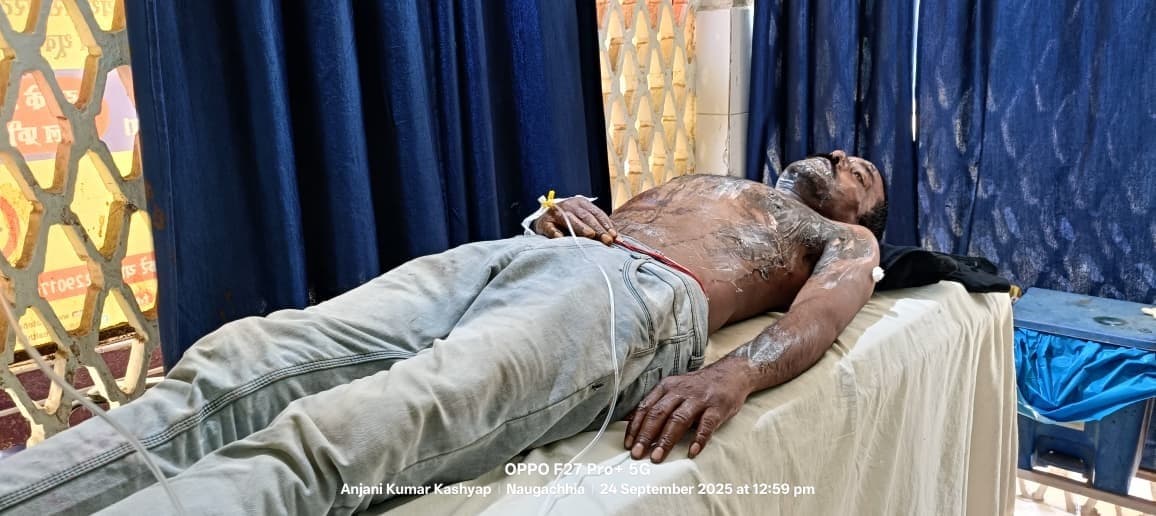 Bhagalpur news जमुनिया में शराब बेचने का विरोध करने पर एसिड अटैक