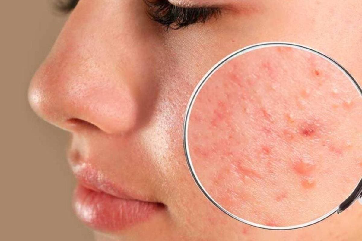 Beauty Tips: Lemon Juice Side Effects