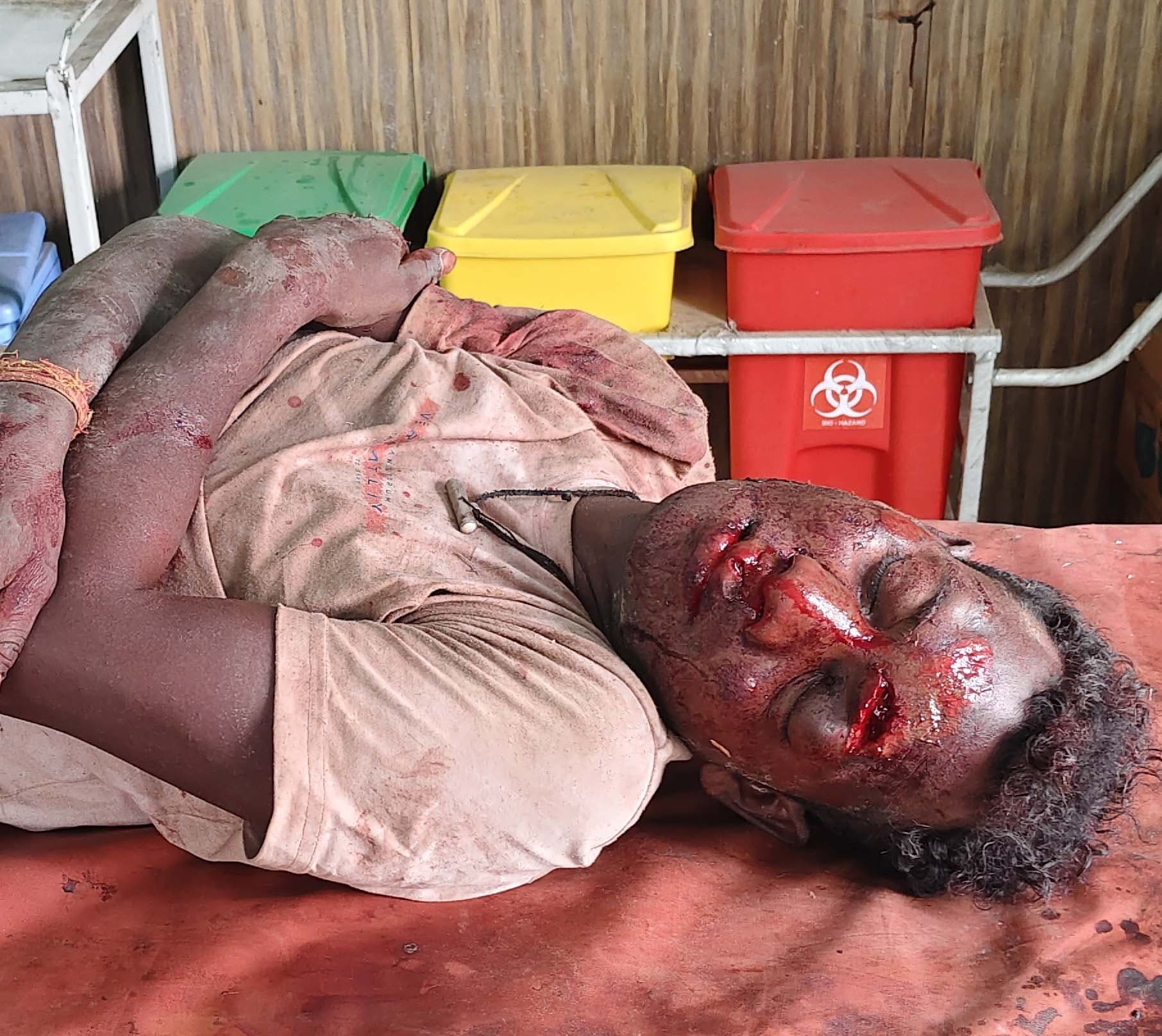 हादसे में बाइक सवार घायल