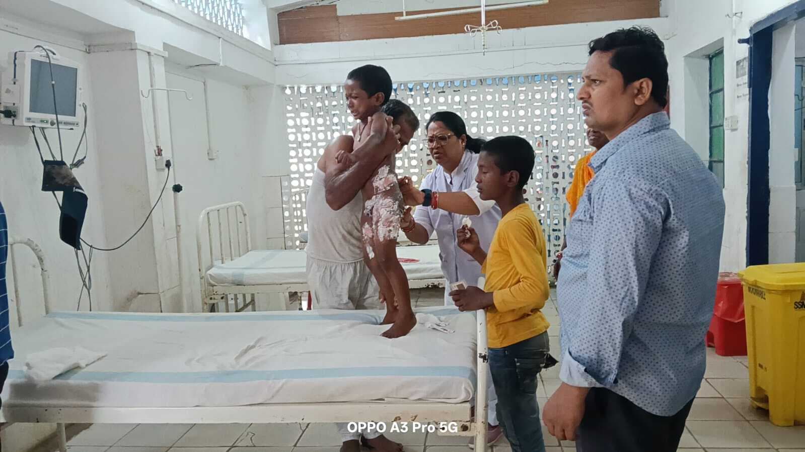 अलमीरा में रखा गर्म दूध बालक के उपर गिरा, रेफर