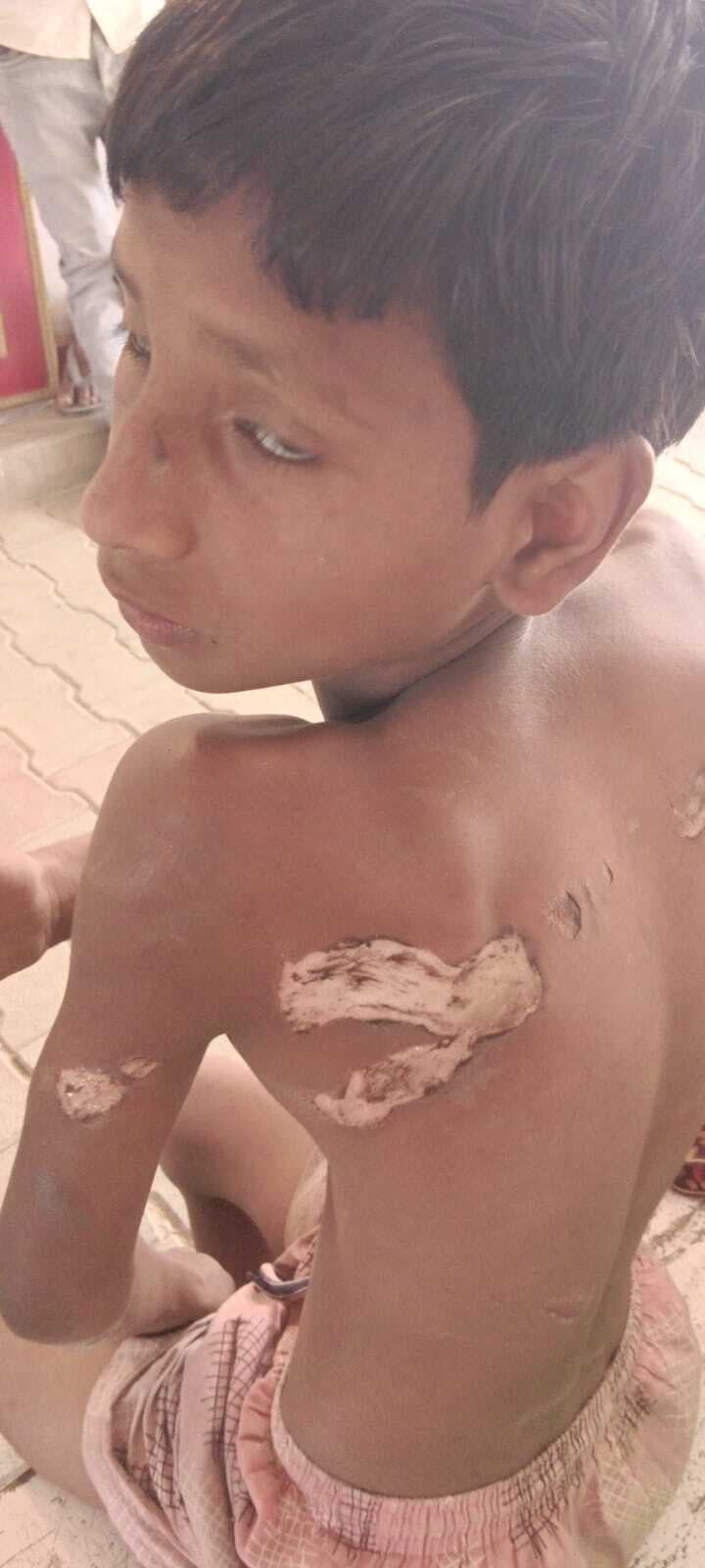 जलाकर मार डालने की कोशिश का मामला थाना पहुंचा