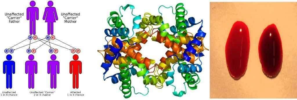 अनुवांशिक बीमारी थैलेसीमिया