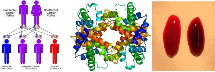 अनुवांशिक बीमारी थैलेसीमिया