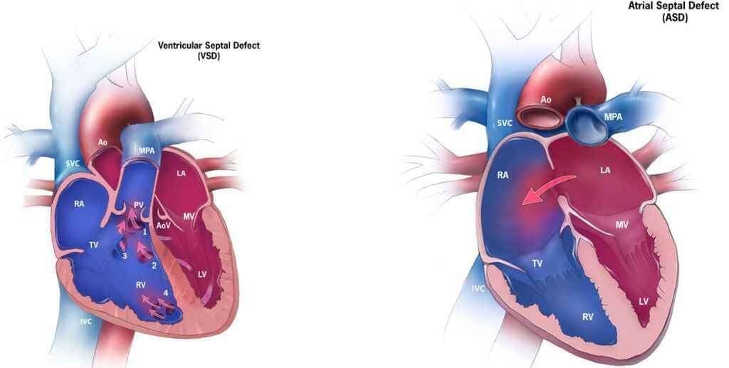 बच्चे के दिल में छेद है तो घबराएं नहीं...परामर्श ले.
