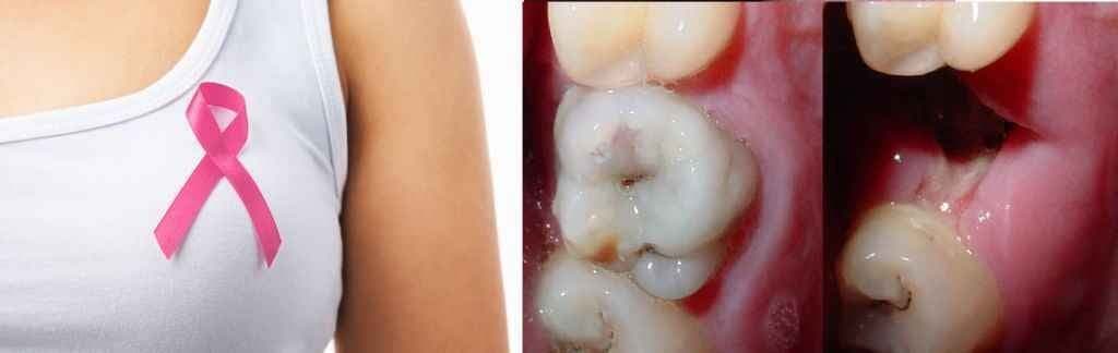 मसूड़ों की बीमारी से बढ़ जाता है ‘ब्रेस्ट कैंसर’ होने का खतरा: रिसर्च