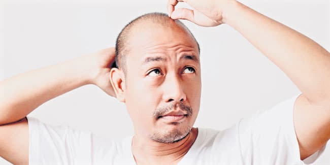 करें ये उपाए तो दूर होगा गंजापन