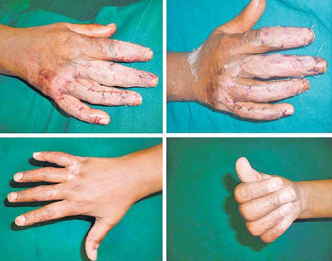 प्लास्टिक सजर्री से ठीक होंगे झुलसने के निशान