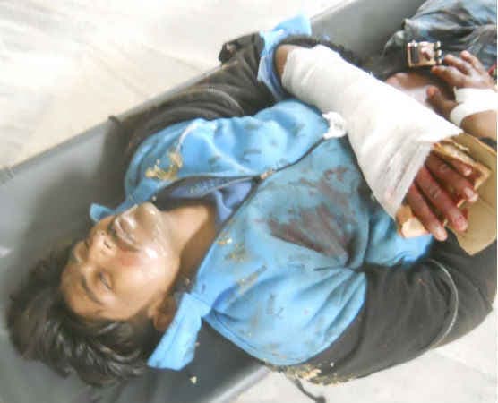 पटना में बैंक लूट कर भाग रहे लुटेरे का लोगों ने काट दिया हाथ