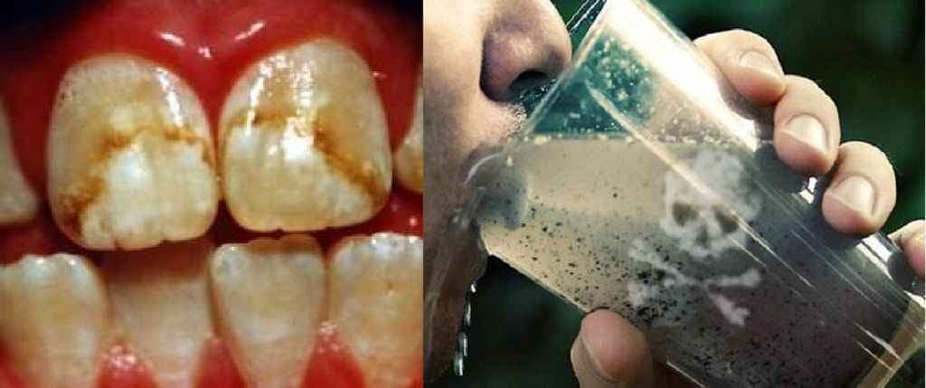 बच्चों के लिए जहर है ‘फ्लोराइड युक्त पानी’
