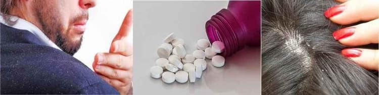 क्या डैंड्रफ है? तो ‘एस्पिरिन’ लीजिए...